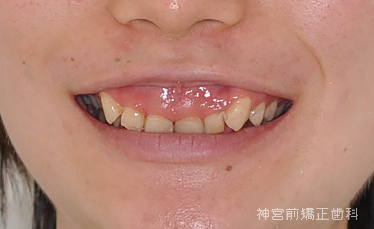 Before