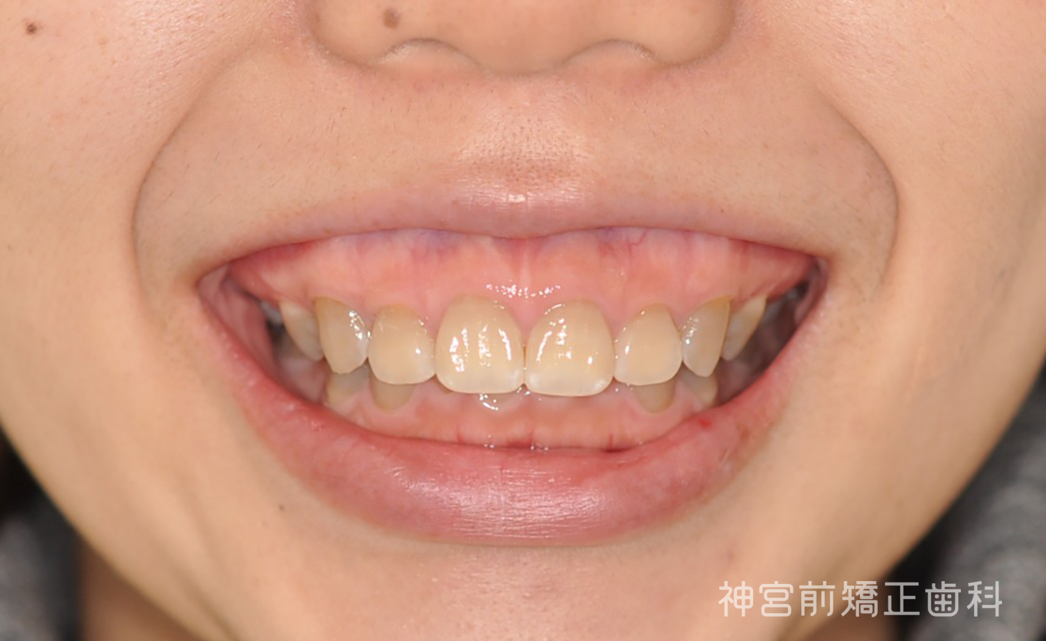 Before