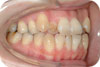 歯列の写真