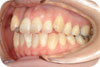 歯列の写真